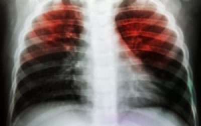 International Workshop On TB Surveillance, Control and Management