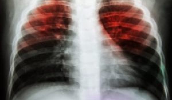 International Workshop On TB Surveillance, Control and Management